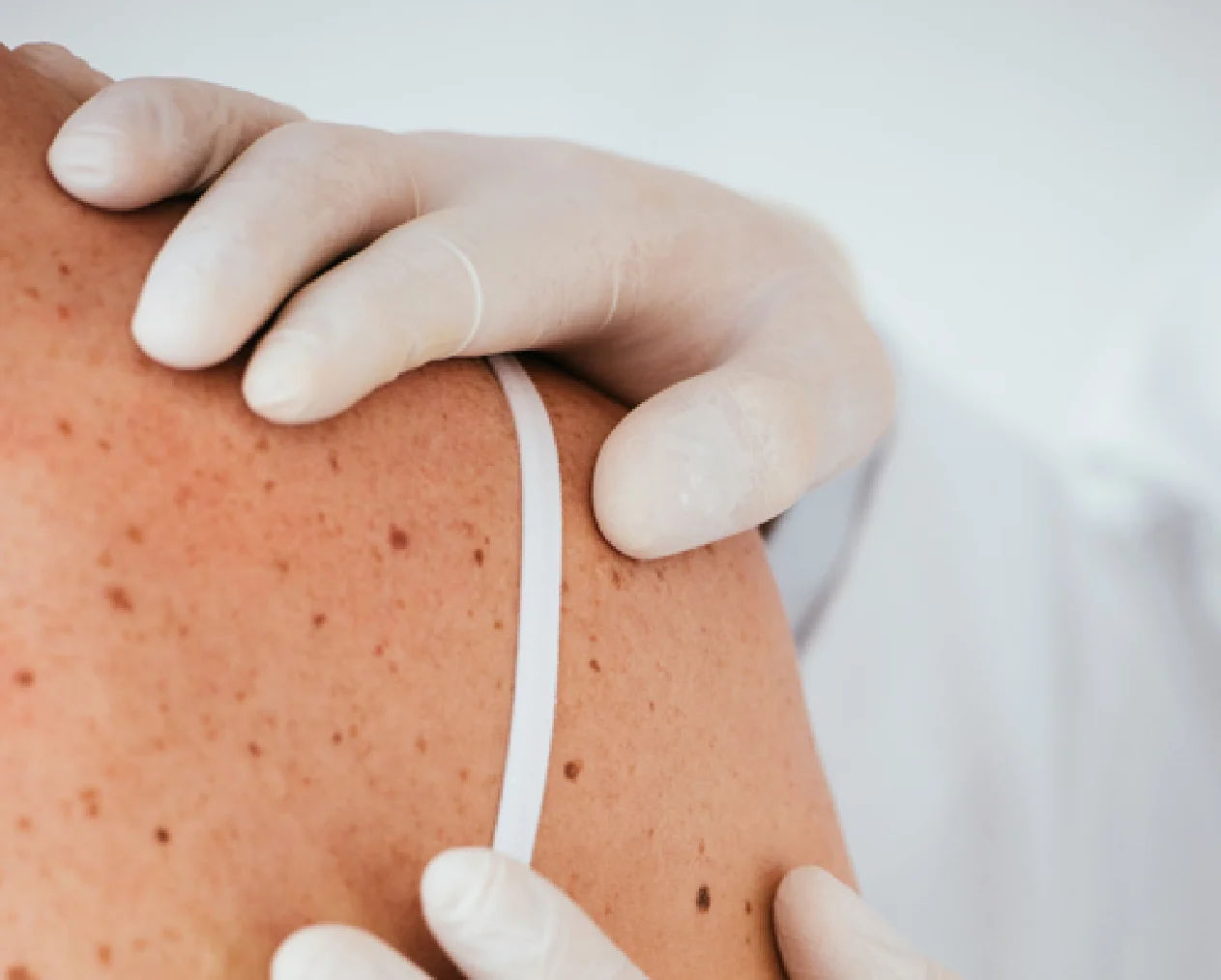 Skin check | Andrew Place Clinic | Mill Park and Bundoora